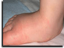 swollen_foot